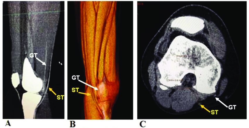 Preoperative Determination of the Size of the Semitendinosus and Gracilis Tendon by Multidetector Row CT Scanner for Anterior Cruciate Ligament Reconstruction Original Article